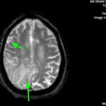 ARIA. T2 Flair Axial 2 Annotated