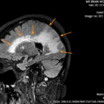ARIA. T2 Flair Sagittal Annotated. JETem 2026