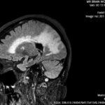 ARIA. T2 Flair Sagittal. JETem 2026