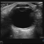Chorionic Hemangiomas in Sturge Weber Syndrome. Normal left ultrasound. JETem 2026