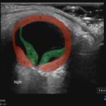 Chorionic Hemangiomas in Sturge Weber Syndrome. Ultrasound annotated. JETem 2026