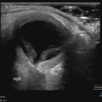 Chorionic Hemangiomas in Sturge Weber Syndrome. Ultrasound. JETem 2026