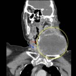 Expanding Neck Mass. CT Coronal Annotated. JETem 2026
