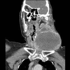 A Rapidly Expanding Neck Mass with Risk of Airway Compromise: A Case Report 3 Expanding Neck Mass. CT Coronal Unannotated. JETem 2026