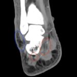 Infectious Flexor Tenosynovitis. CT Coronal Annotated. JETem 2026