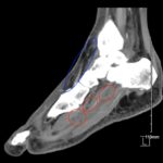 Infectious Flexor Tenosynovitis. CT Sagittal Annotated. JETem 2026