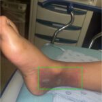 Infectious Flexor Tenosynovitis. Photo 1 Annotated. JETem 2026