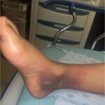 Infectious Flexor Tenosynovitis. Photo 1. JETem 2026