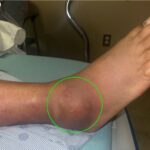 Infectious Flexor Tenosynovitis. Photo 2 Annotated. JETem 2026