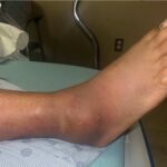 Infectious Flexor Tenosynovitis. Photo 2. JETem 2026