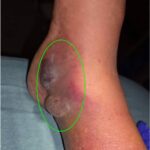 Infectious Flexor Tenosynovitis. Photo 3 Annotated. JETem 2026