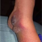 Infectious Flexor Tenosynovitis. Photo 3. JETem 2026