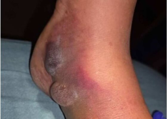 Infectious Flexor Tenosynovitis of the Lower Extremity: A Case Report 2 Infectious Flexor Tenosynovitis. Photo 3. JETem 2026