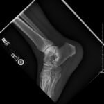 Infectious Flexor Tenosynovitis. X Ray. JETem 2026