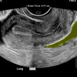 Ovarian Cyst Mimicking Ruptured Ectopic Pregnancy. Transvaginal US 1 Annotated. JETem 2026