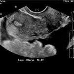 Ovarian Cyst Mimicking Ruptured Ectopic Pregnancy. Transvaginal US 2. JETem 2026