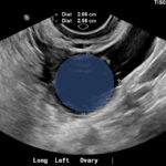 Ovarian Cyst Mimicking Ruptured Ectopic Pregnancy. Transvaginal US 3 Annotated. JETem 2026