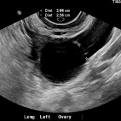 Ovarian Cyst Mimicking Ruptured Ectopic Pregnancy. Transvaginal US 3. JETem 2026