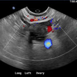 Ovarian Cyst Mimicking Ruptured Ectopic Pregnancy. Transvaginal US Ovary Doppler. JETem 2026