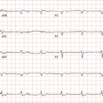 Shockingly Unreliable. Post Cardioversion ECG. JETem 2026