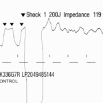 Shockingly Unreliable. Post Cardioversion Rhythm Strip. JETem 2026